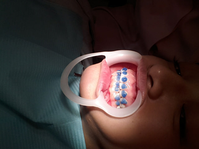 牙套生活-首部曲