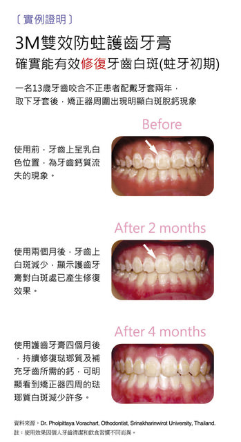 牙齒的保健課題-3M雙效防蛀護齒牙膏