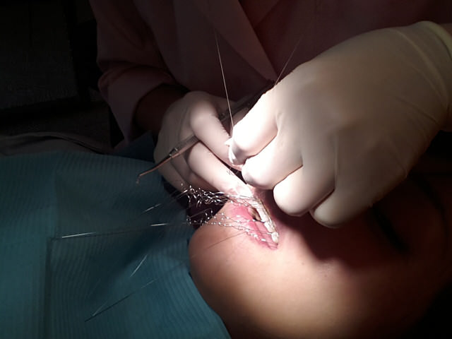 牙套生活-首部曲